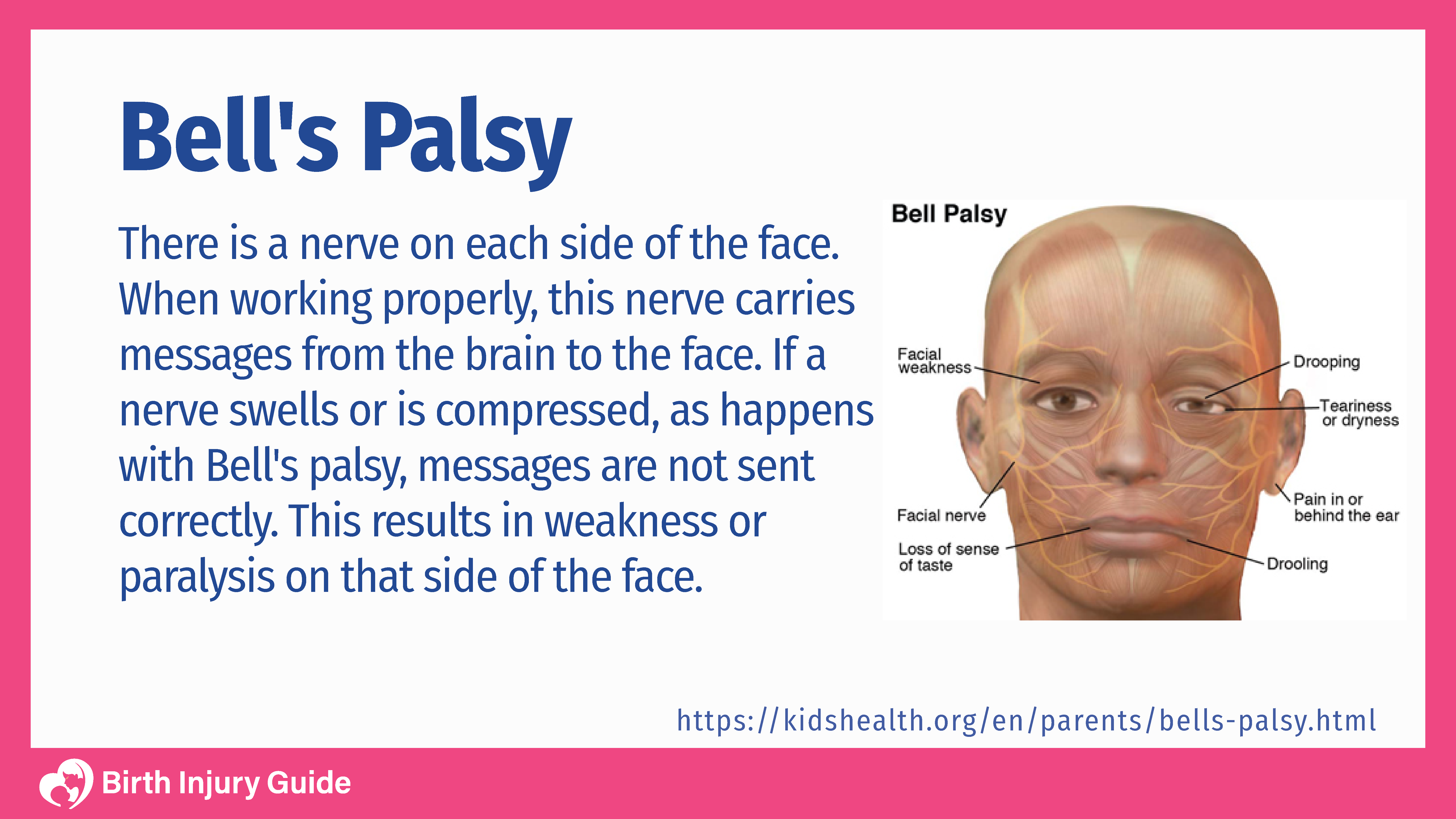 Bell S Palsy Handbook Facial Nerve Palsy Or Bell S Palsy Facial