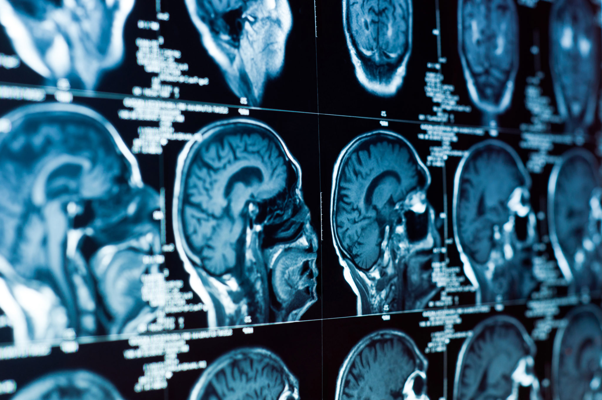 Could Brain Growth Chart Spot Attention >> Symptoms Of Infant Brain Damage Birth Injury Guide Could Brain Growth Chart Spot Attention >> Symptoms Of Infant Brain Damage Birth Injury Guide