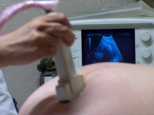Brain Injuries at Birth - houston attorney