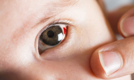 subconjunctival hemorrhage, Jessa Seewald, Duggar