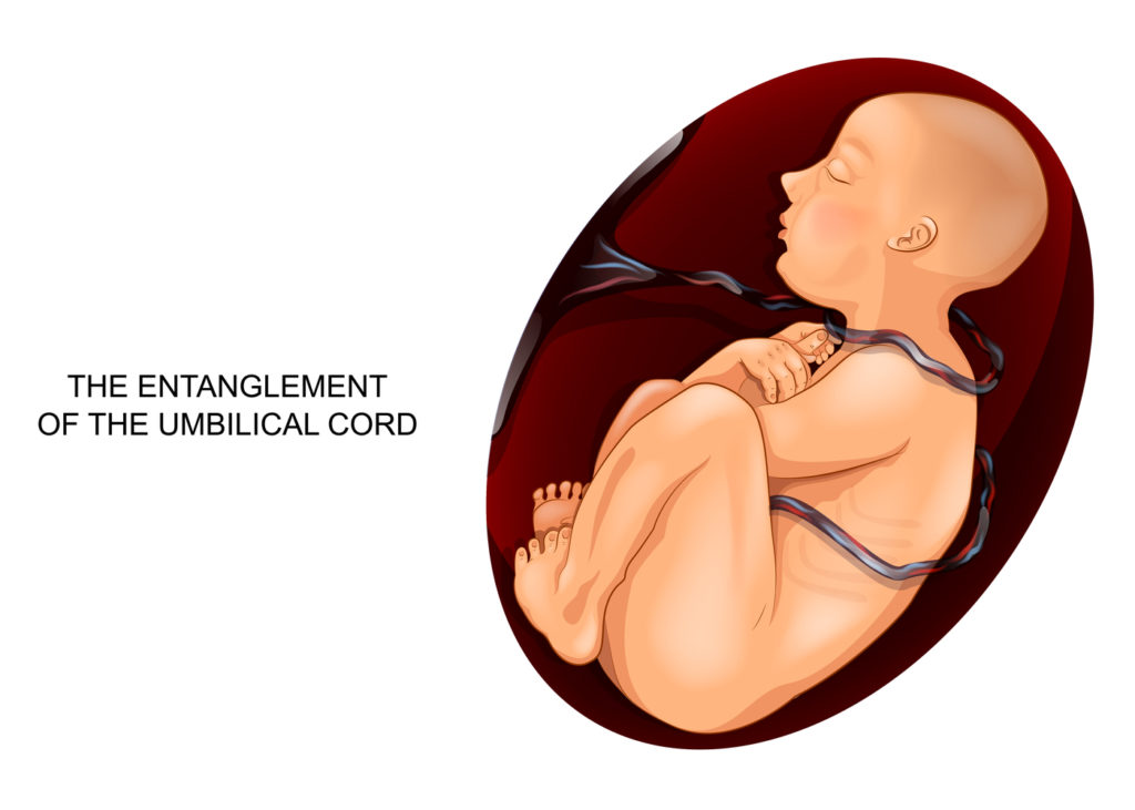 nuchal cord birth injury