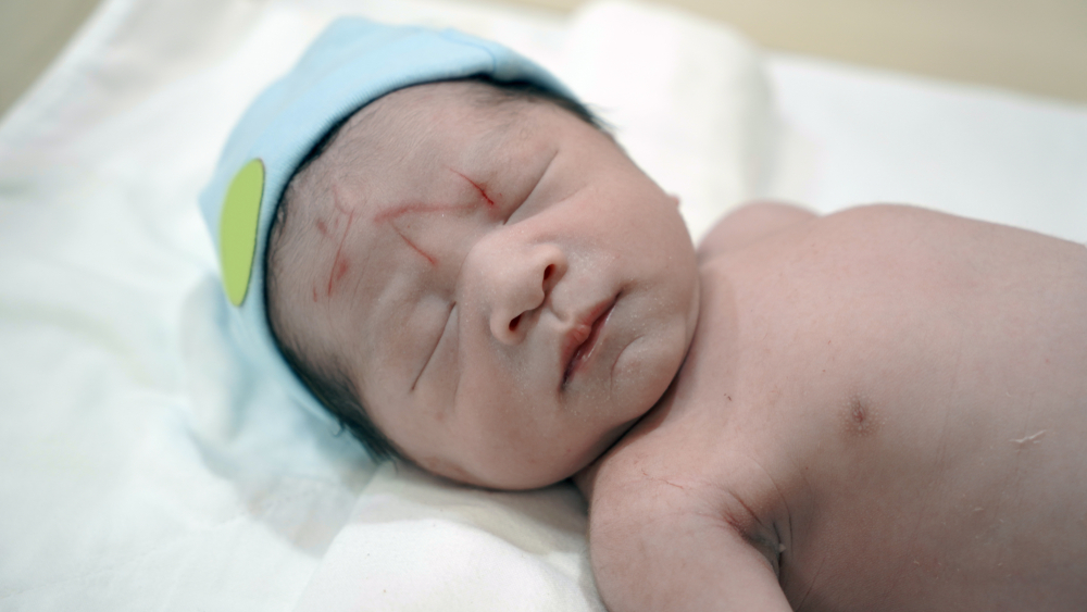 Fetal Lacerations Birth Injury Guide