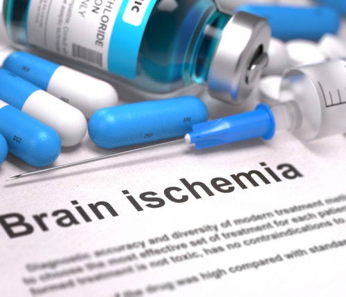 infant brain ischemia