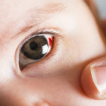 subconjunctival hemorrhage