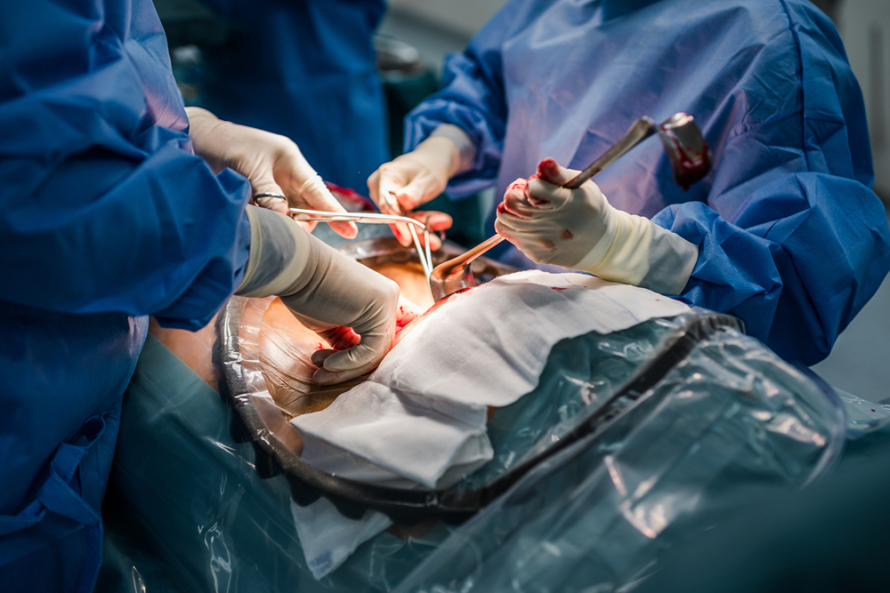 C-Section Injuries: Risks and Complications | Birth Injury Guide