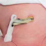 premature cord clamping