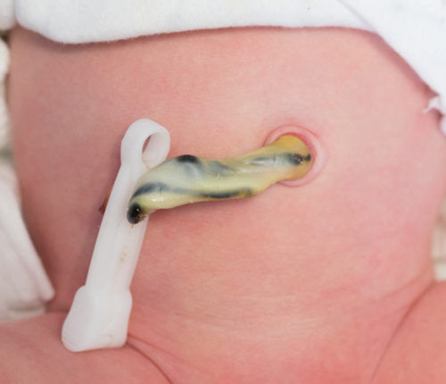 premature cord clamping