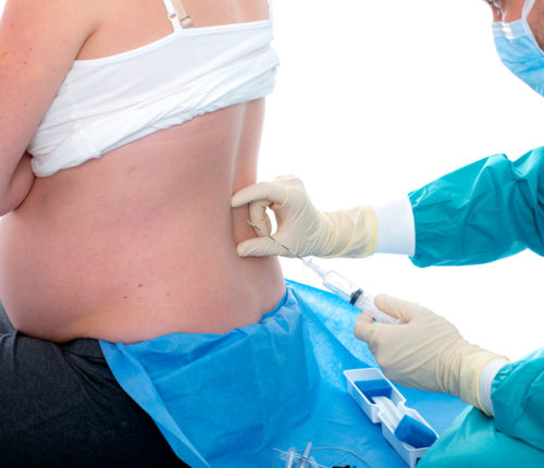 epidural birth injuries