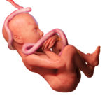 umbilical cord compression