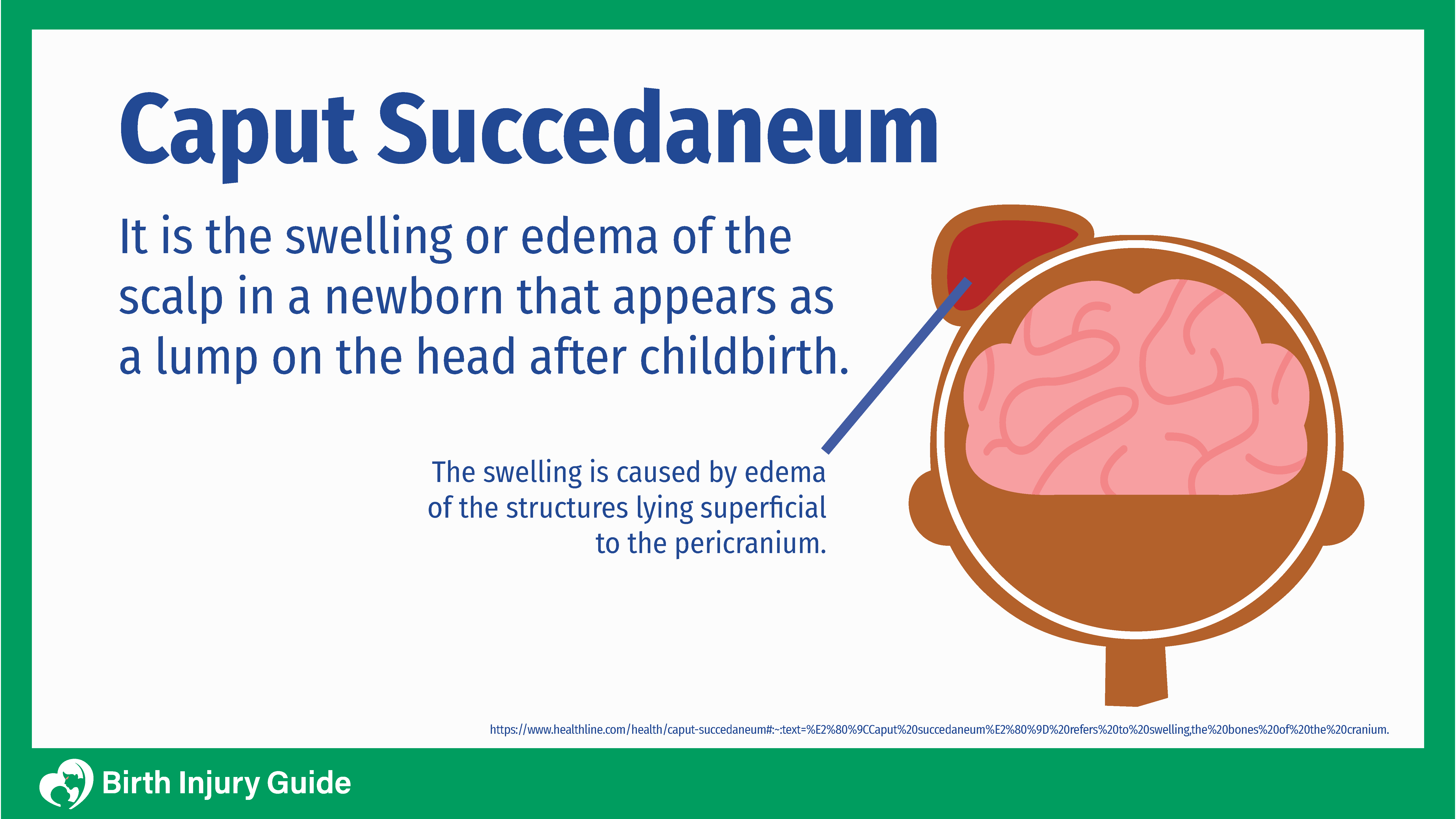 caput succedaneum, swollen brain with edema