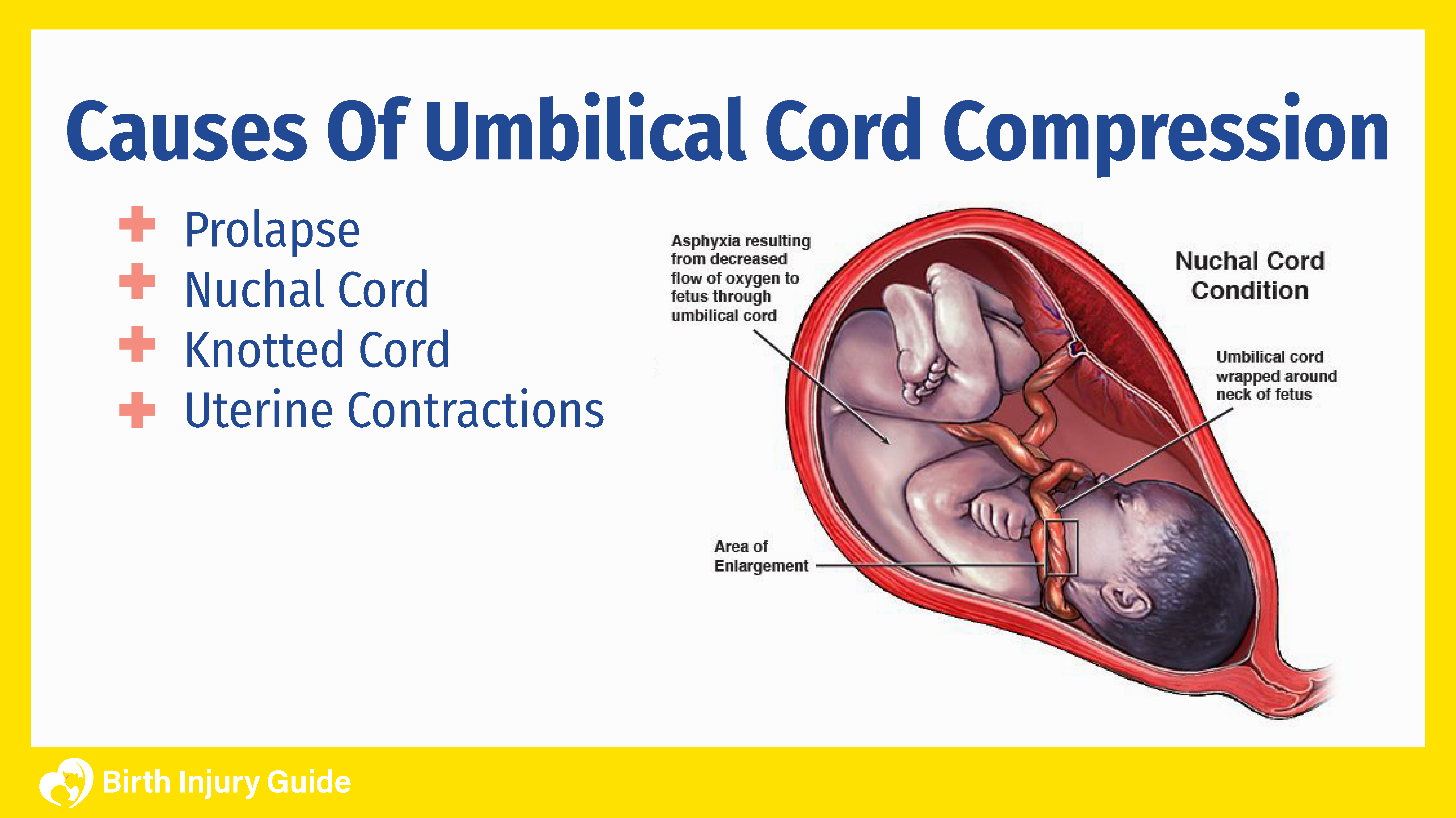 unborn baby with umbilical cord compression and its causes