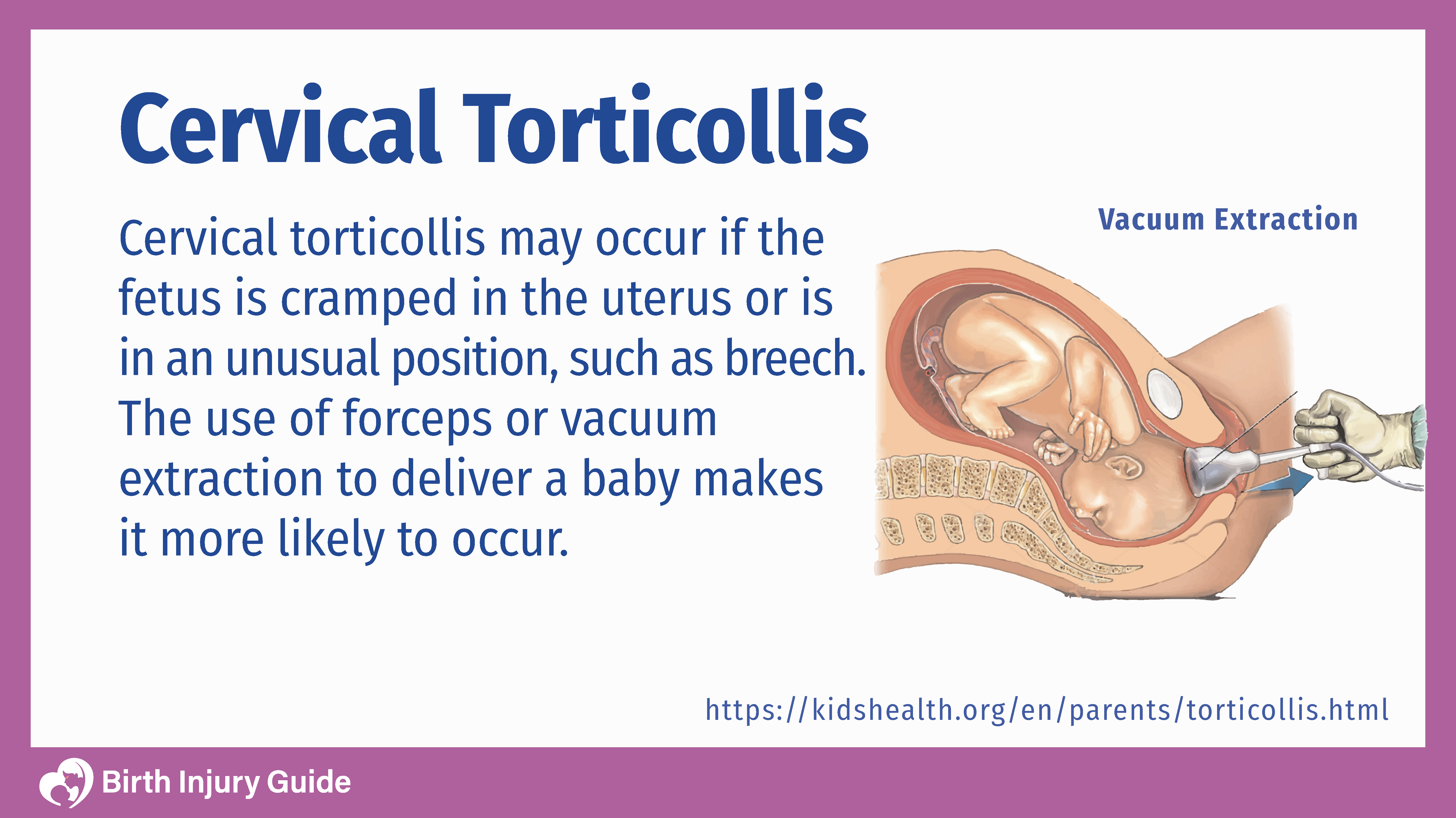 Infant cervical torticollis