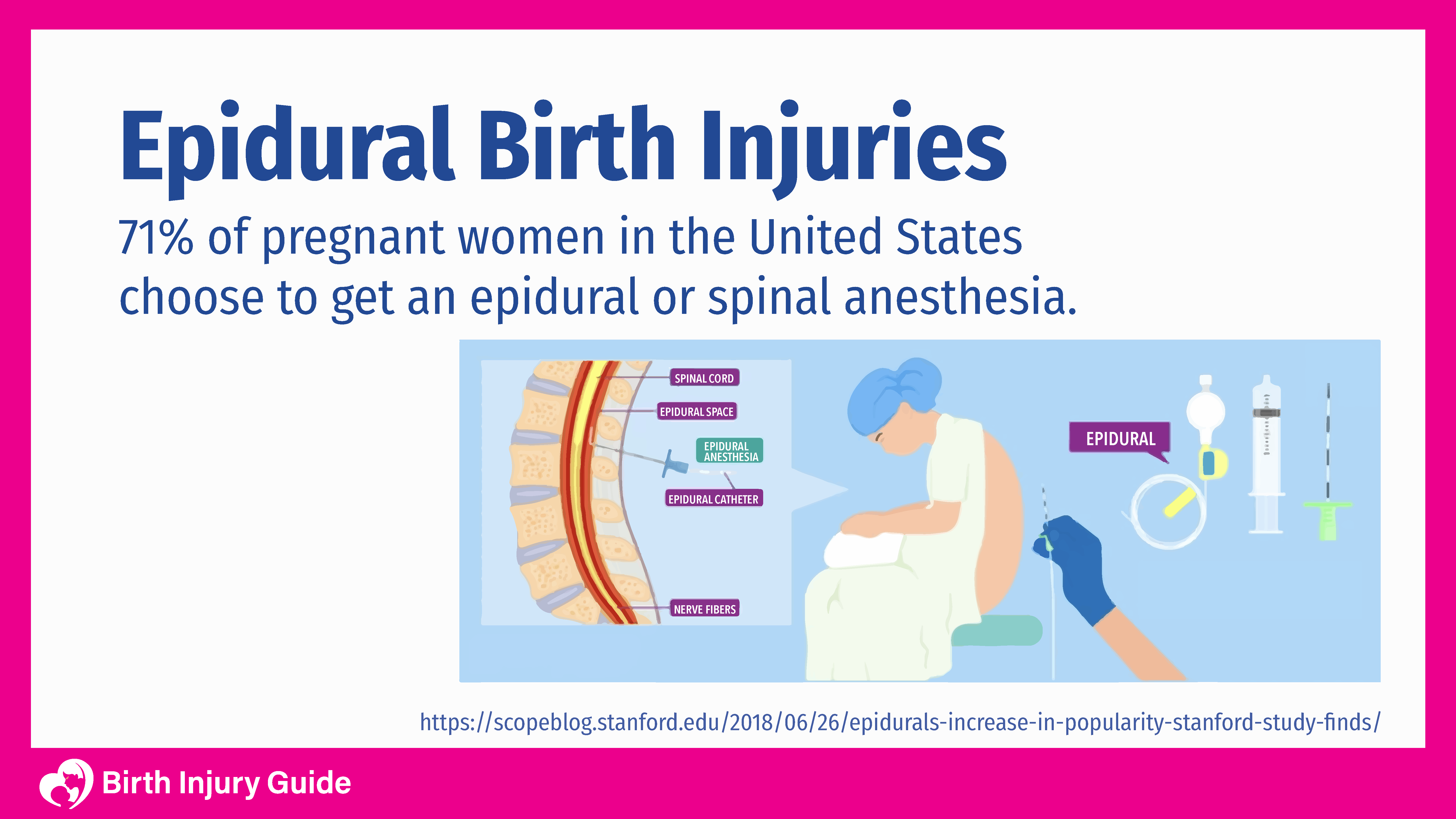 epidural birth injuries