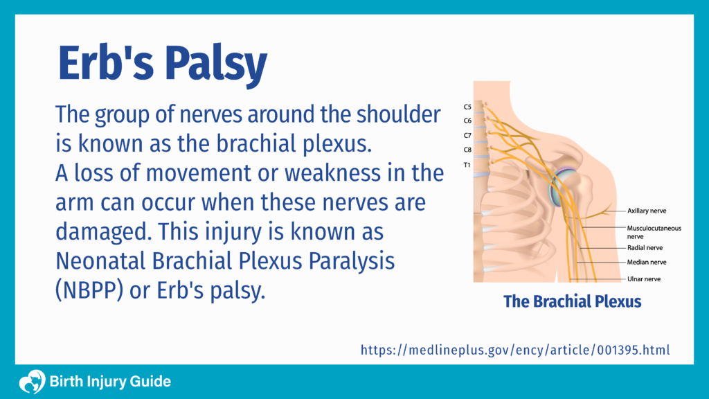 Erb #39 s Palsy: Causes Symptoms and Treatment Birth Injury Guide