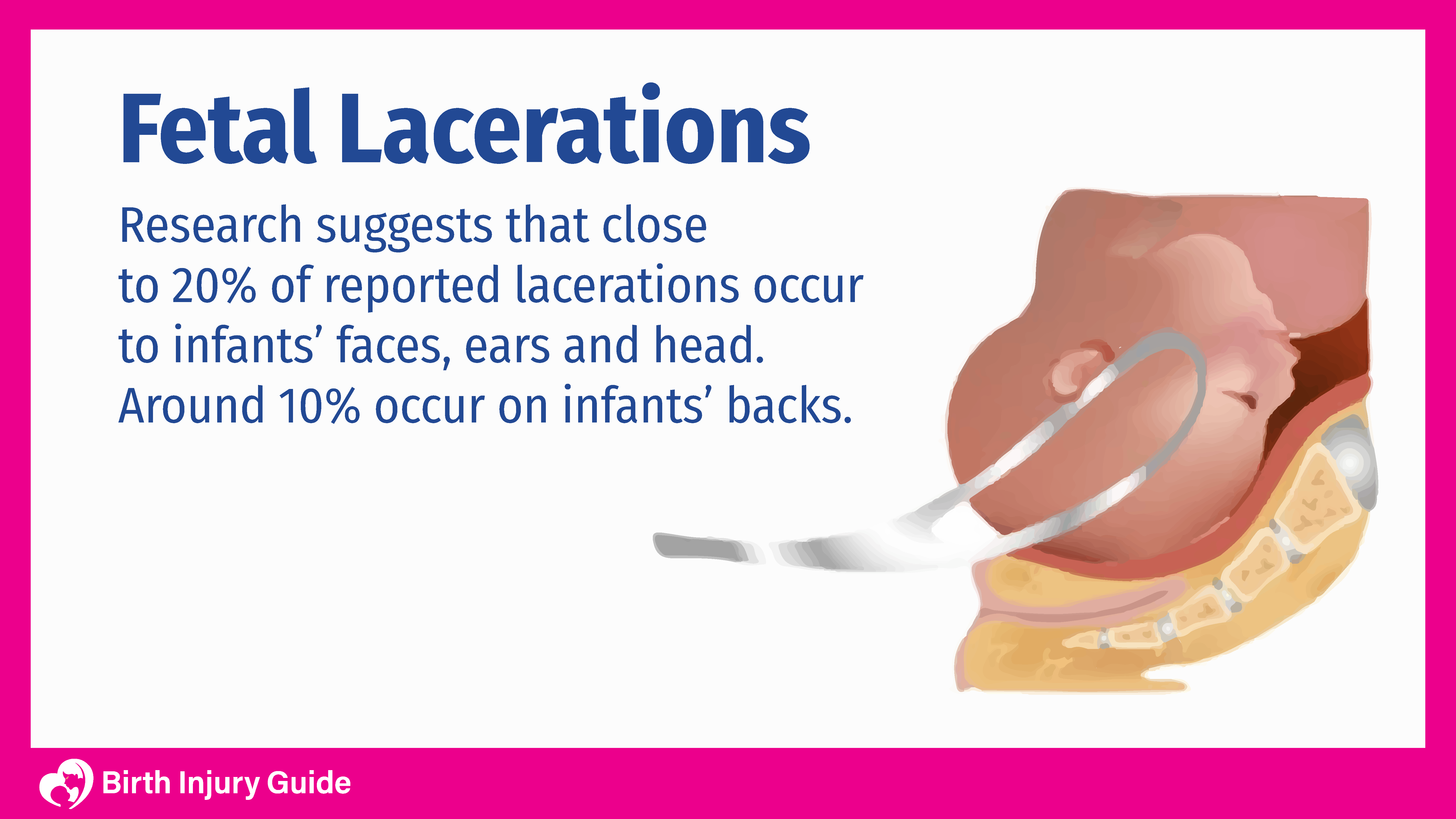 fetal lacerations