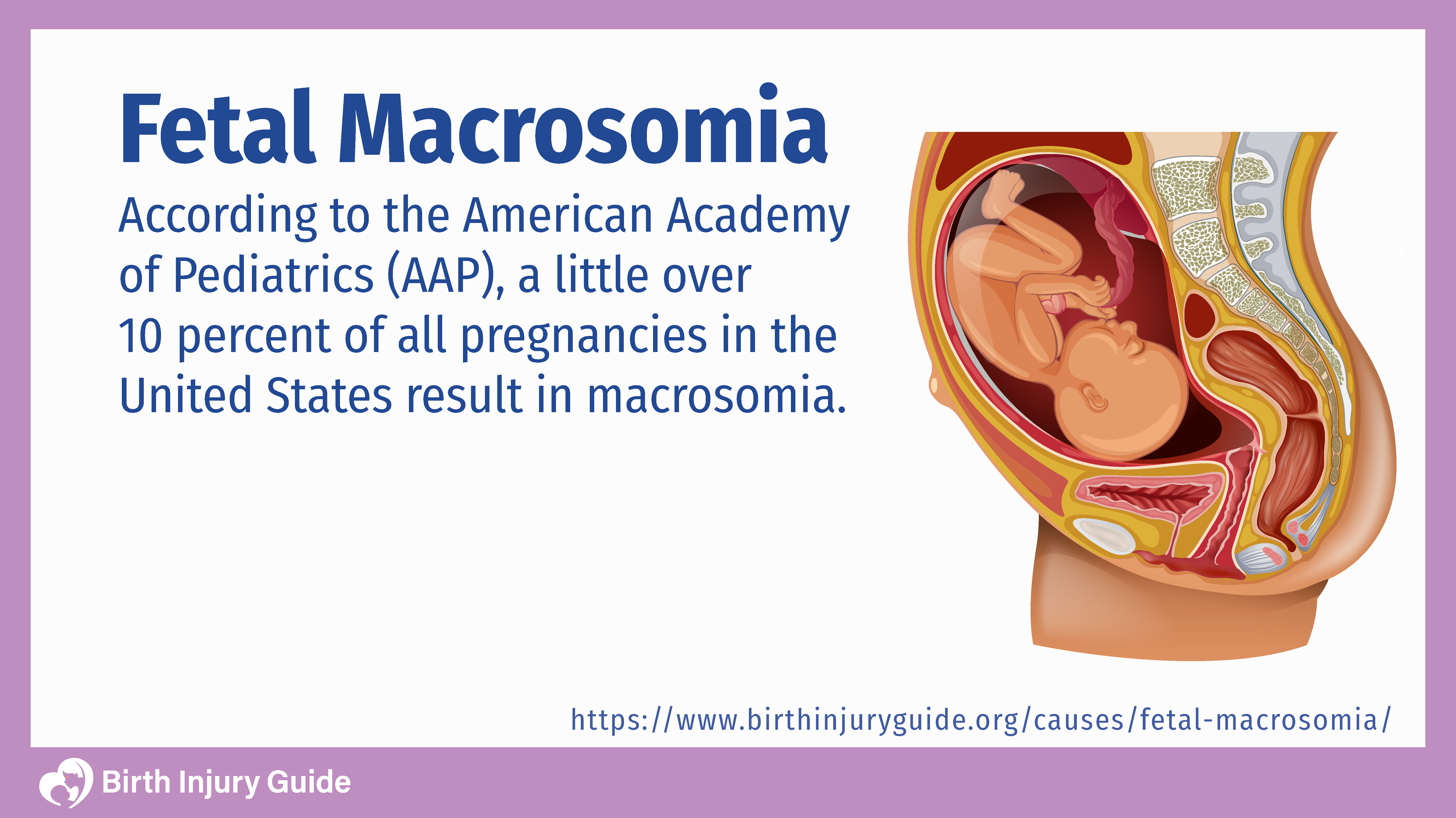 unborn baby with fetal macrosomia 