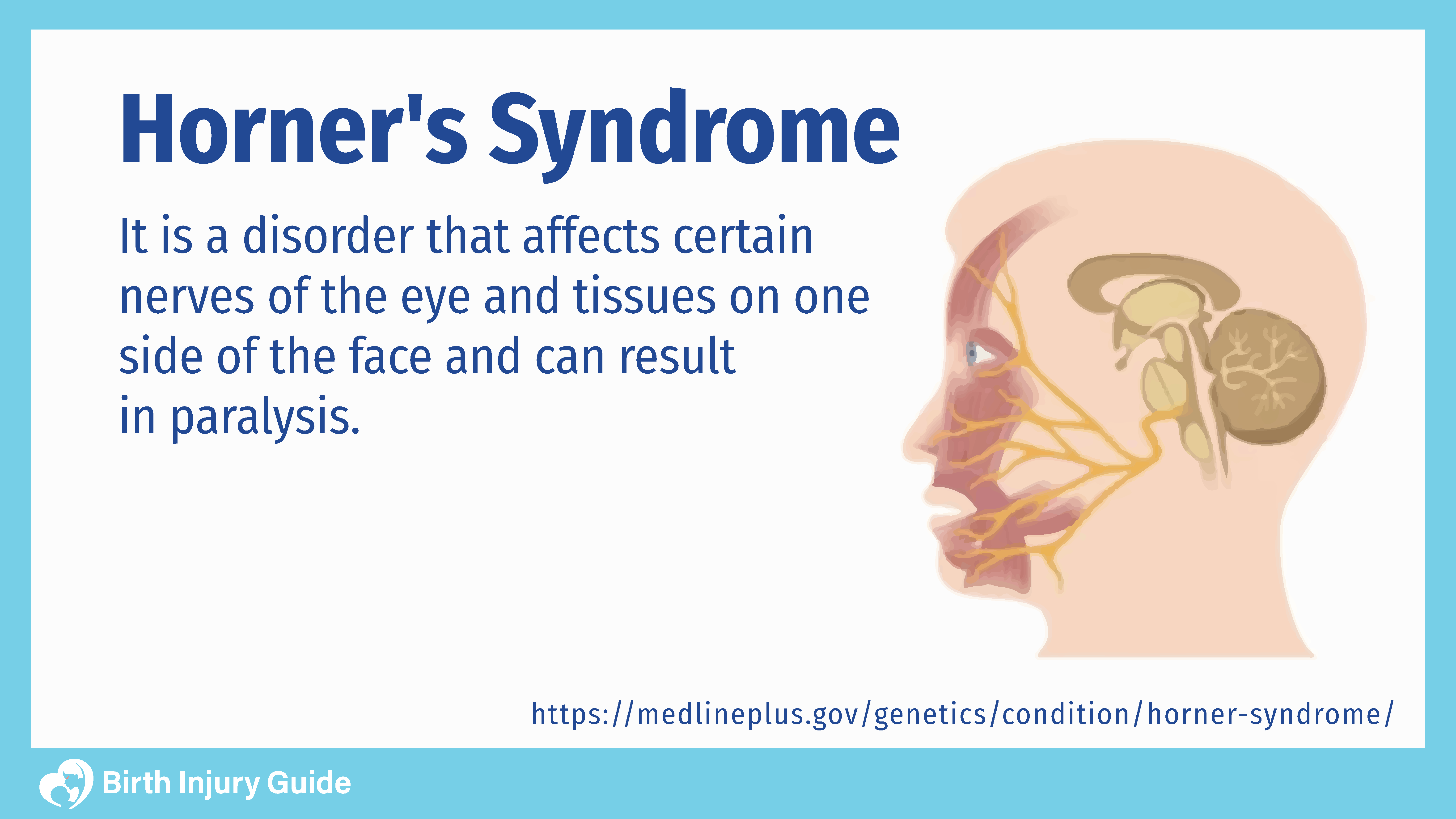 horner's syndrome disorder described. Human face paralyzed due to the syndrome affecting some nerves.