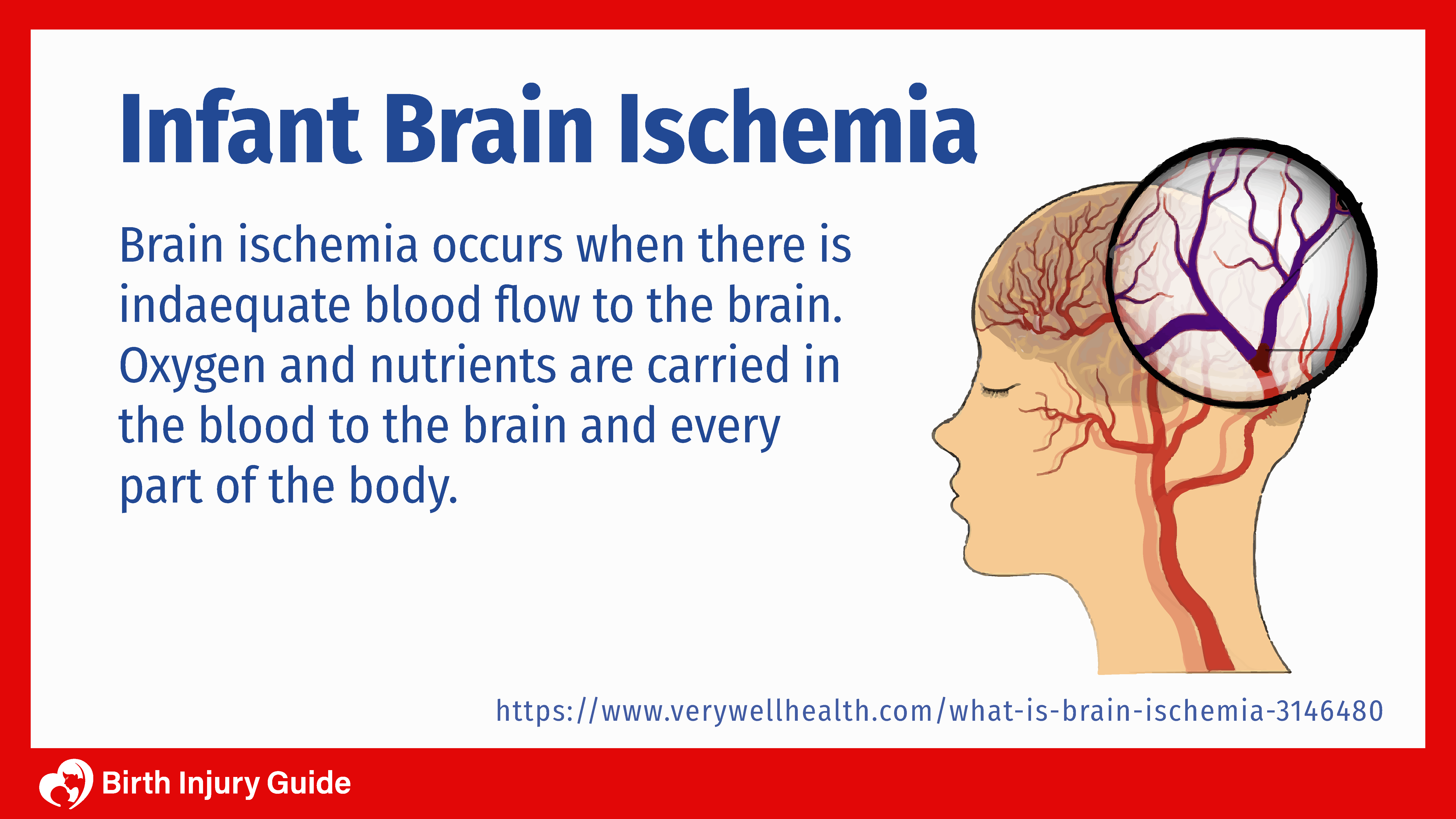 what is infant brain ischemia, brain image with blood flow.