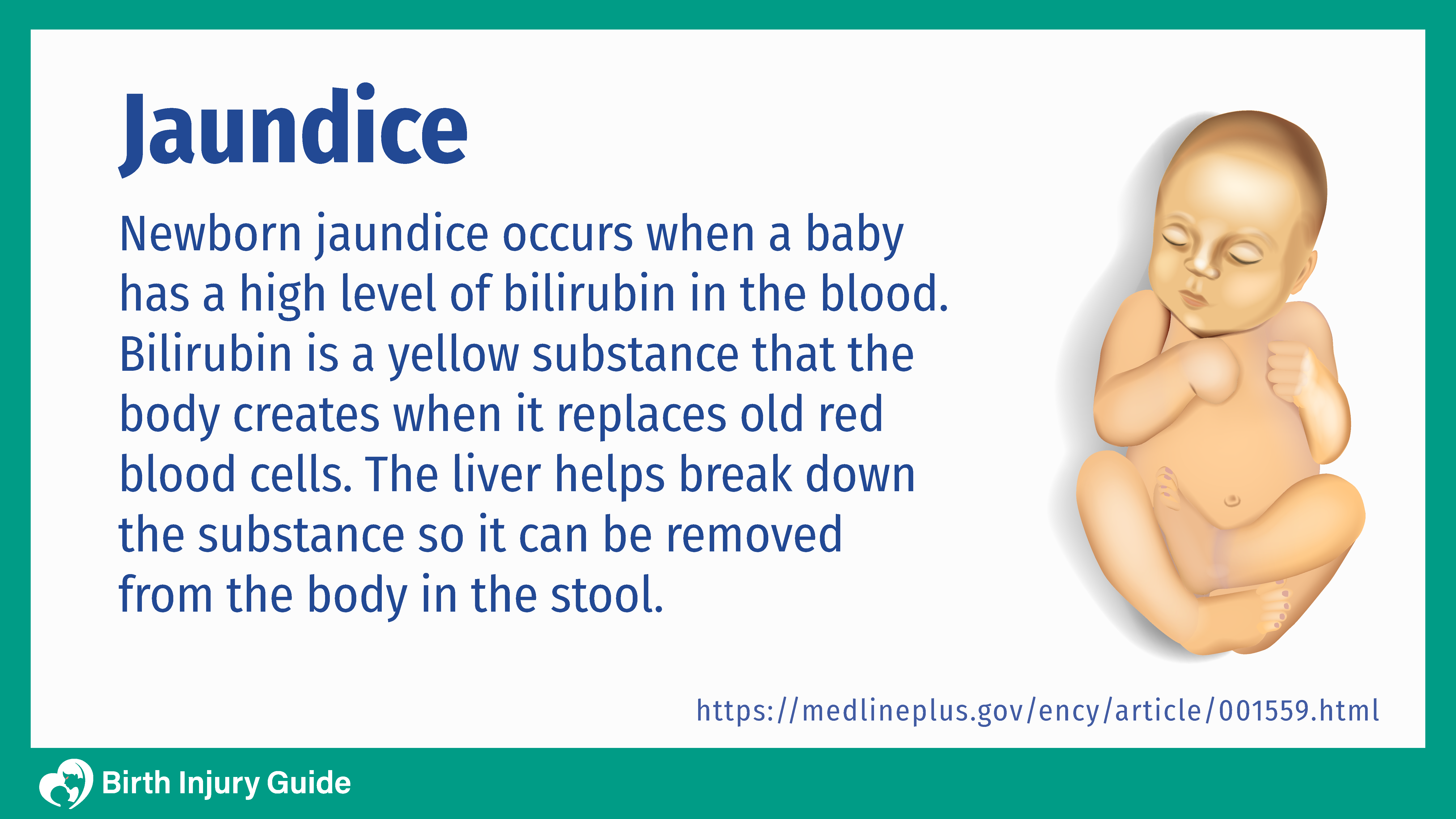 newborn jaundice