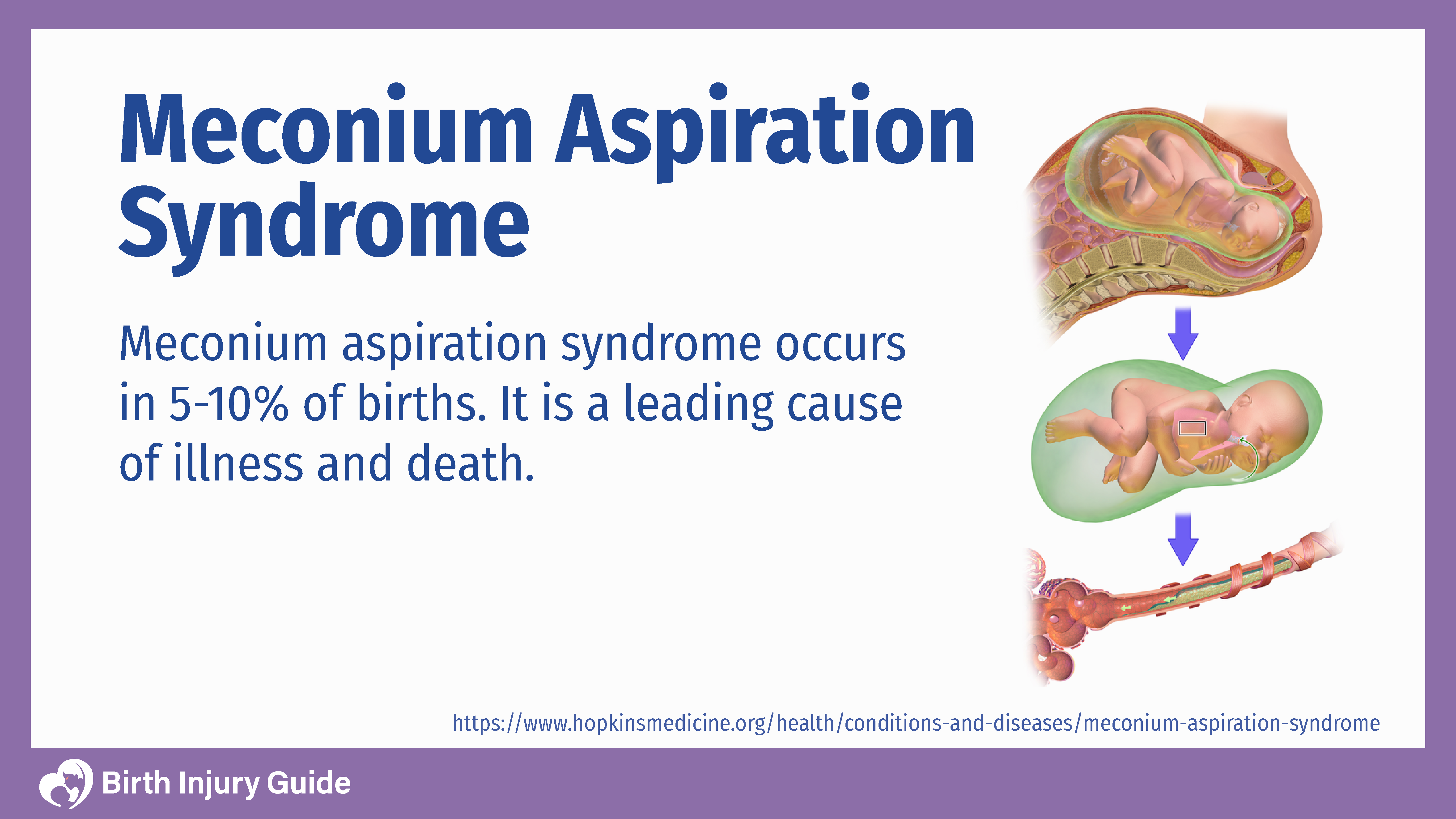 meconium aspiration syndrome occurs in 5-10% of births. Baby inside of a mother's placenta.