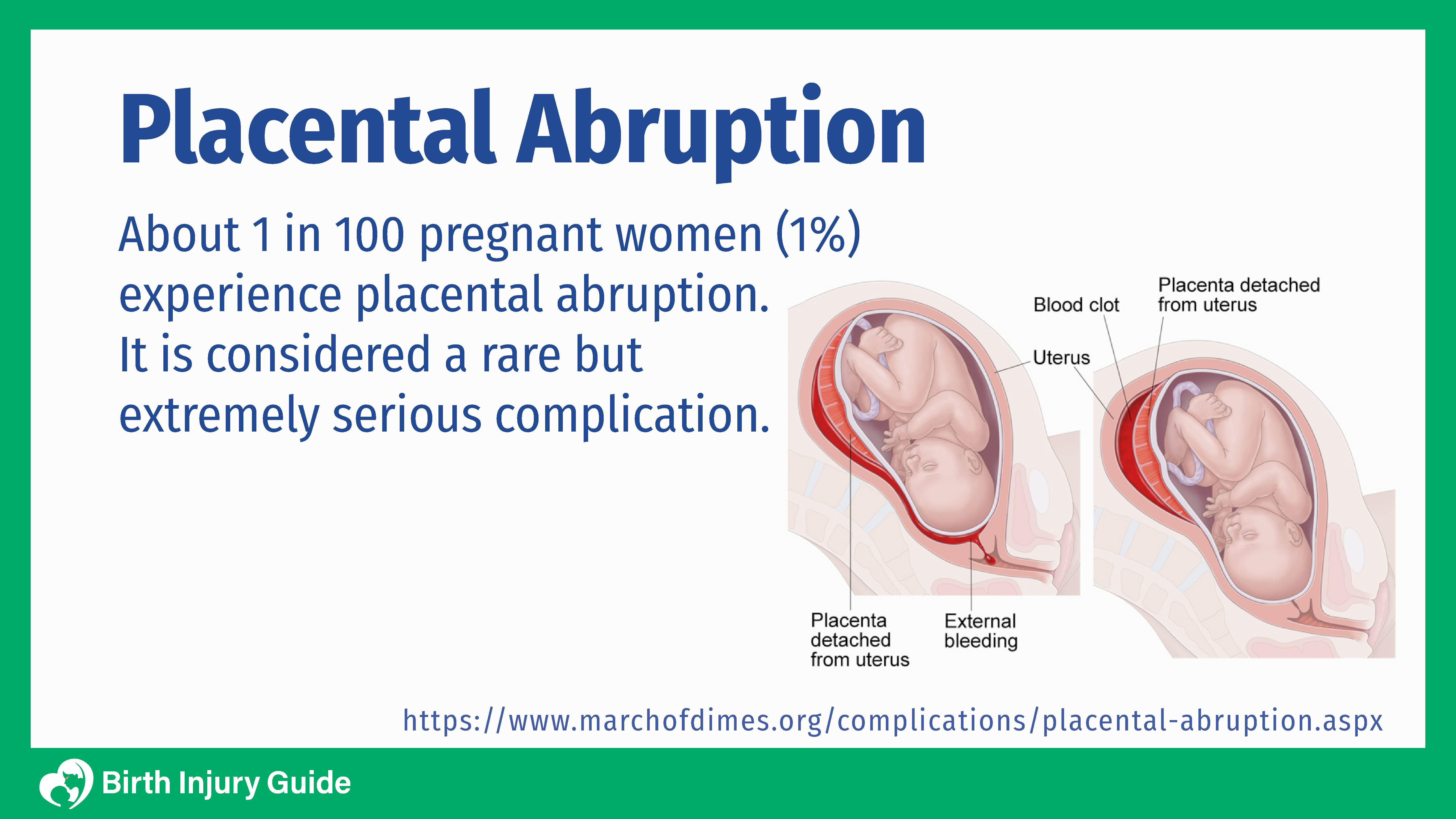 placental abruption