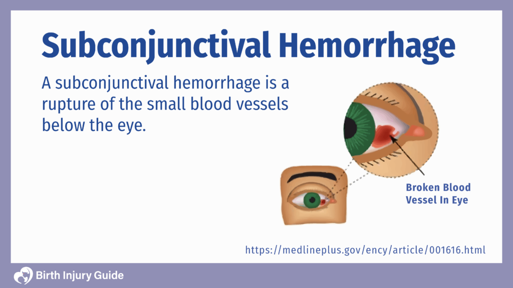 red spot in eye, showing what is a subconjunctival hemorrhage