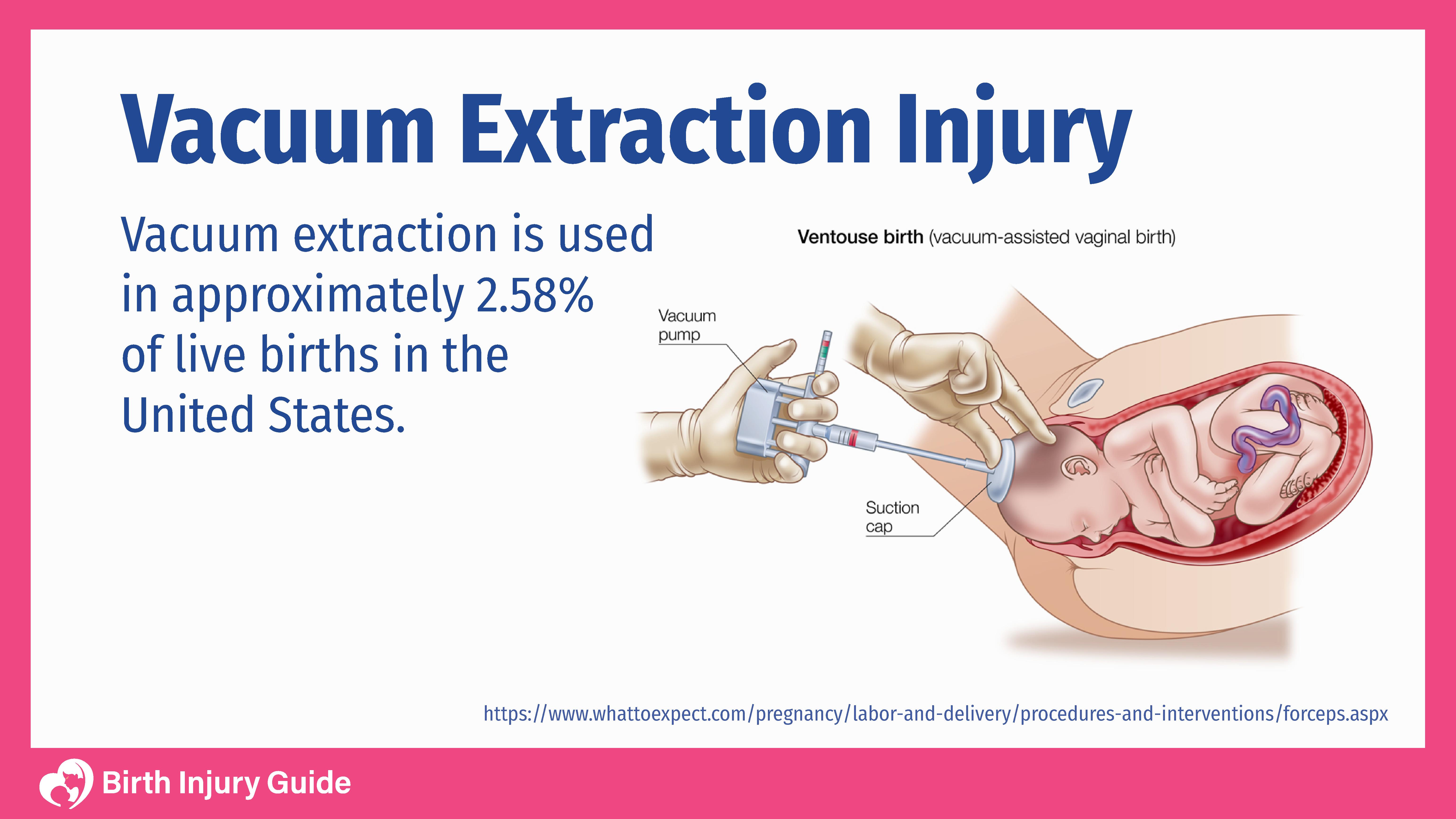 vacuum extraction injury