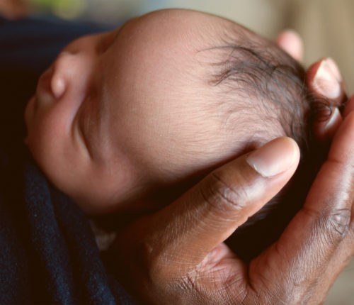 infant cephalohematoma