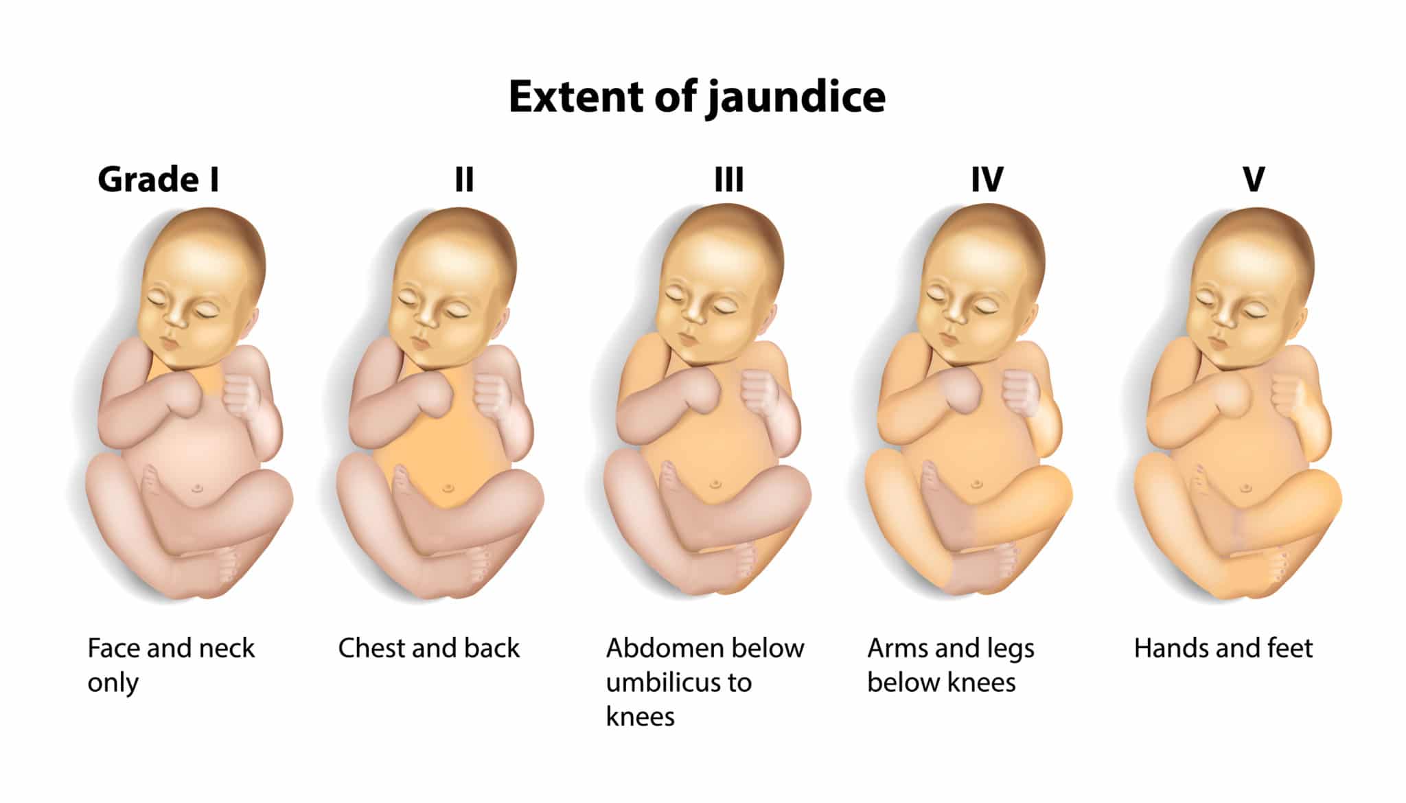 jaundice and caput succedaneum