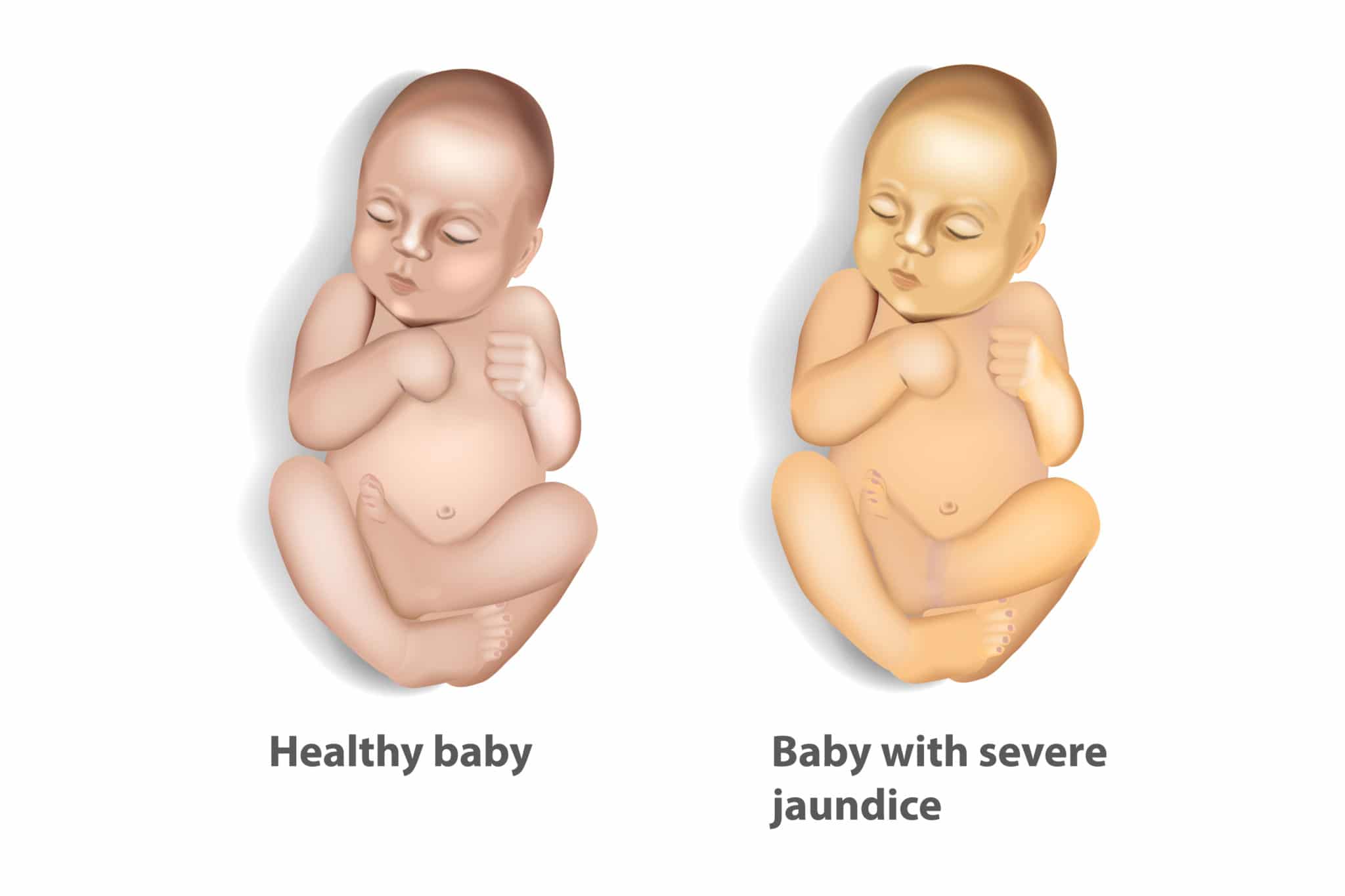 severe jaundice