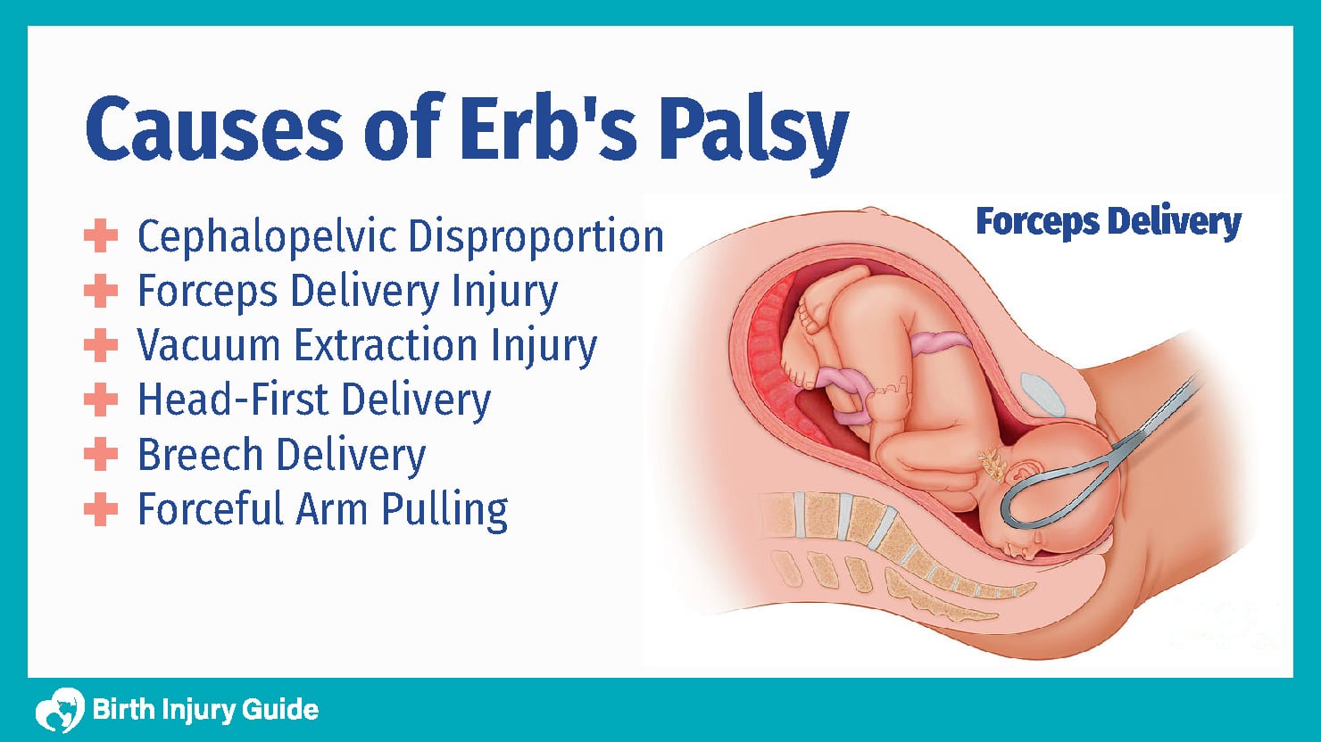causes of erb's palsy