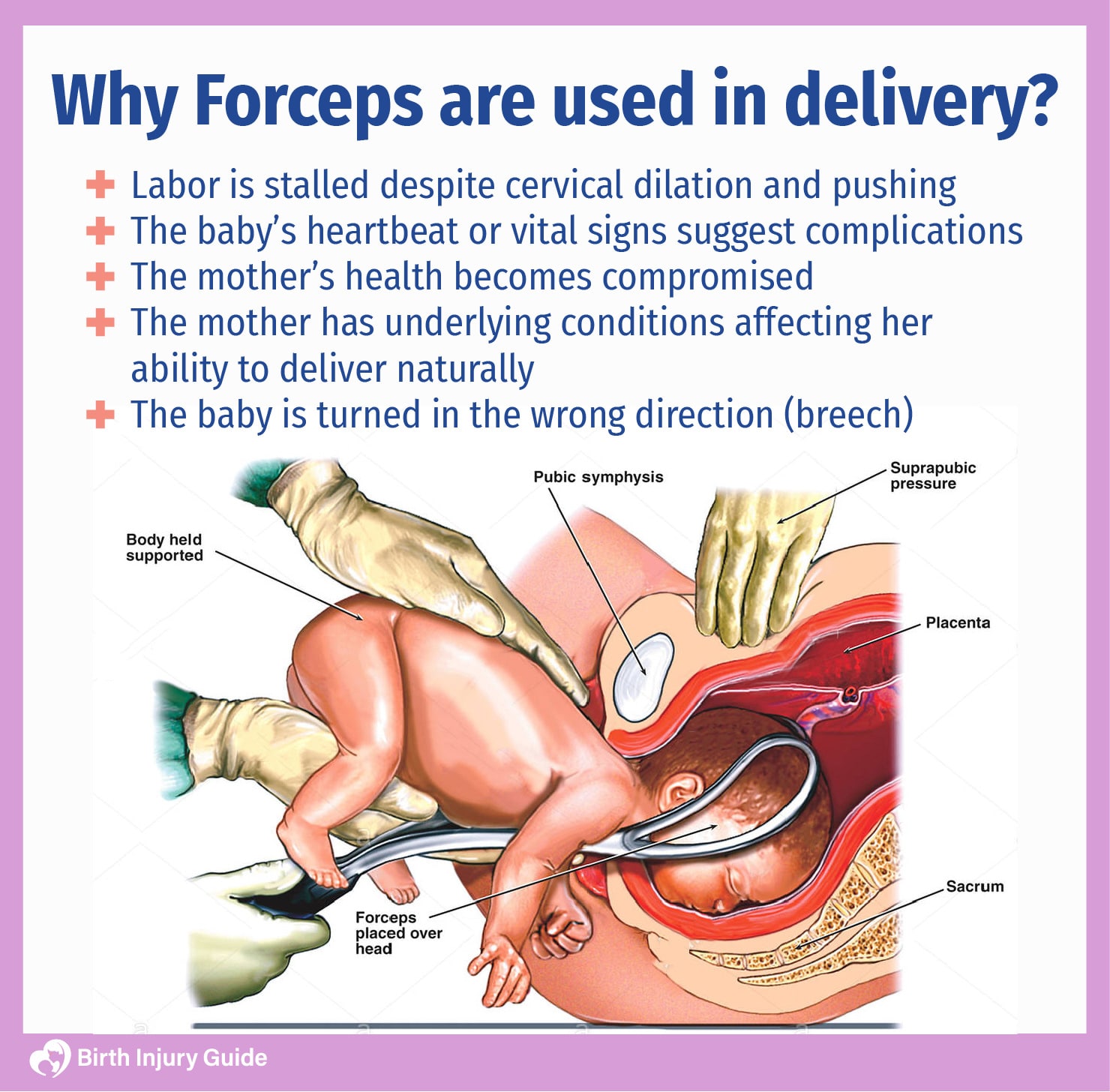 why are forceps used in delivery?